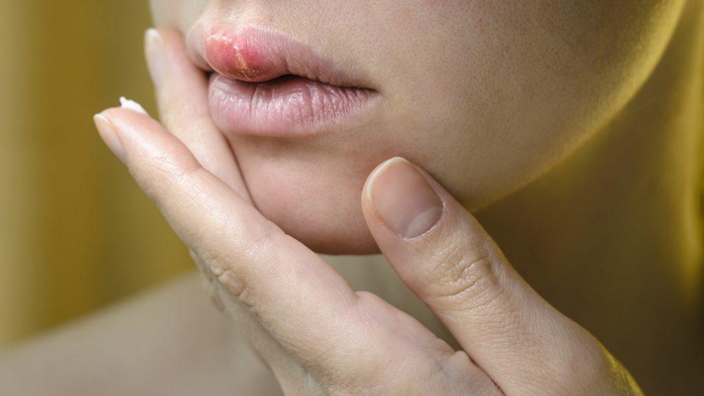 Herpes: principais causas e tratamentos