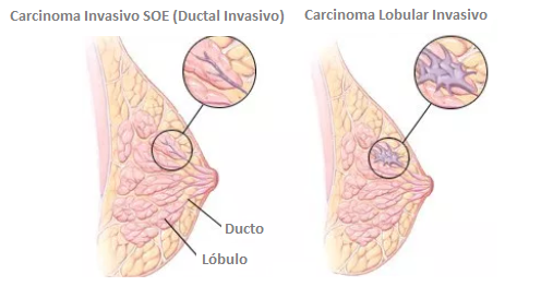 Anatomia Patológica no Câncer de Mama