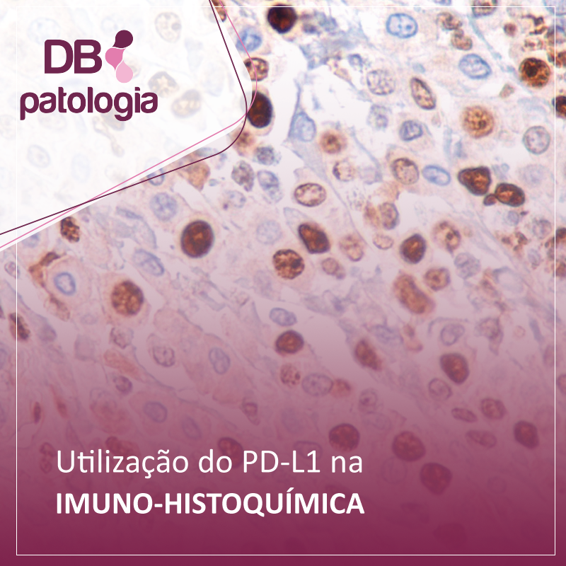 Utilização do PD-L1 na Imuno-histoquímica 