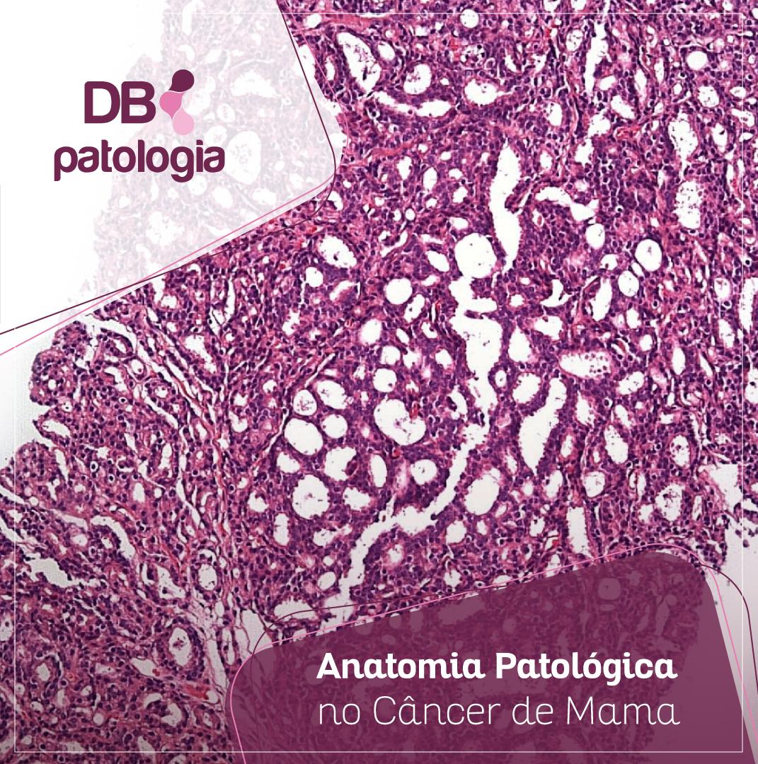 Anatomia Patológica no Câncer de Mama | Diagnósticos do Brasil