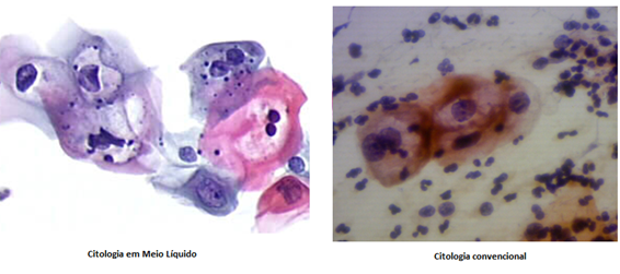 Citologia em Meio Líquido 