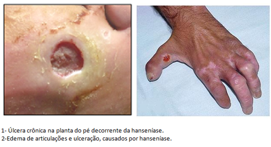 Hanseníase - descubra quais são aa causas, sintomas e tratamento 