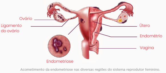 IMUNO HISTOQUÍMICA PAINEL DE INFERTILIDADE