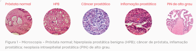 IMUNO-HISTOQUÍMICA PAINEL DE PRÓSTATA