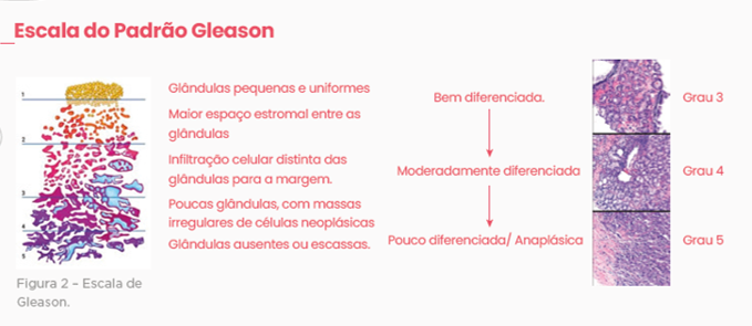 IMUNO-HISTOQUÍMICA PAINEL DE PRÓSTATA