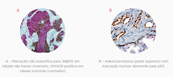 IMUNO-HISTOQUÍMICA PAINEL DE PRÓSTATA