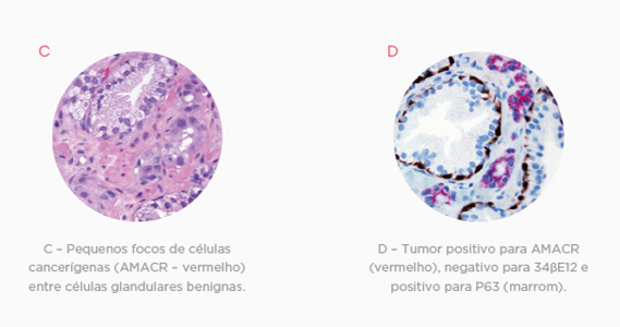 IMUNO-HISTOQUÍMICA PAINEL DE PRÓSTATA