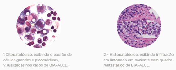 Lamina Linfoma anaplásico de grandes células (ALCL) associado ao implante mamário (BIA)