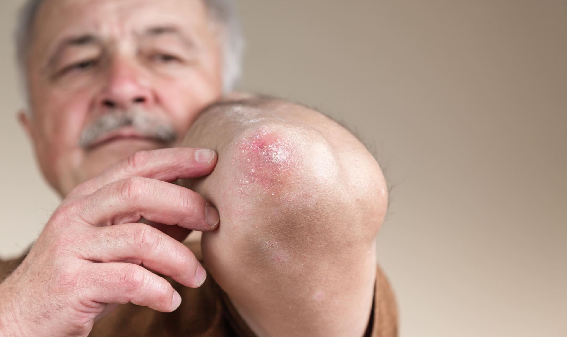 HANSENÍASE SINTOMAS E COMO FICA O CORPO TRANSMISSÃO