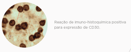 LÂMINA LINFOMA ANAPLÁSICO DE GRANDES CÉLULAS (ALCL) ASSOCIADO AO IMPLANTE MAMÁRIO (BIA)