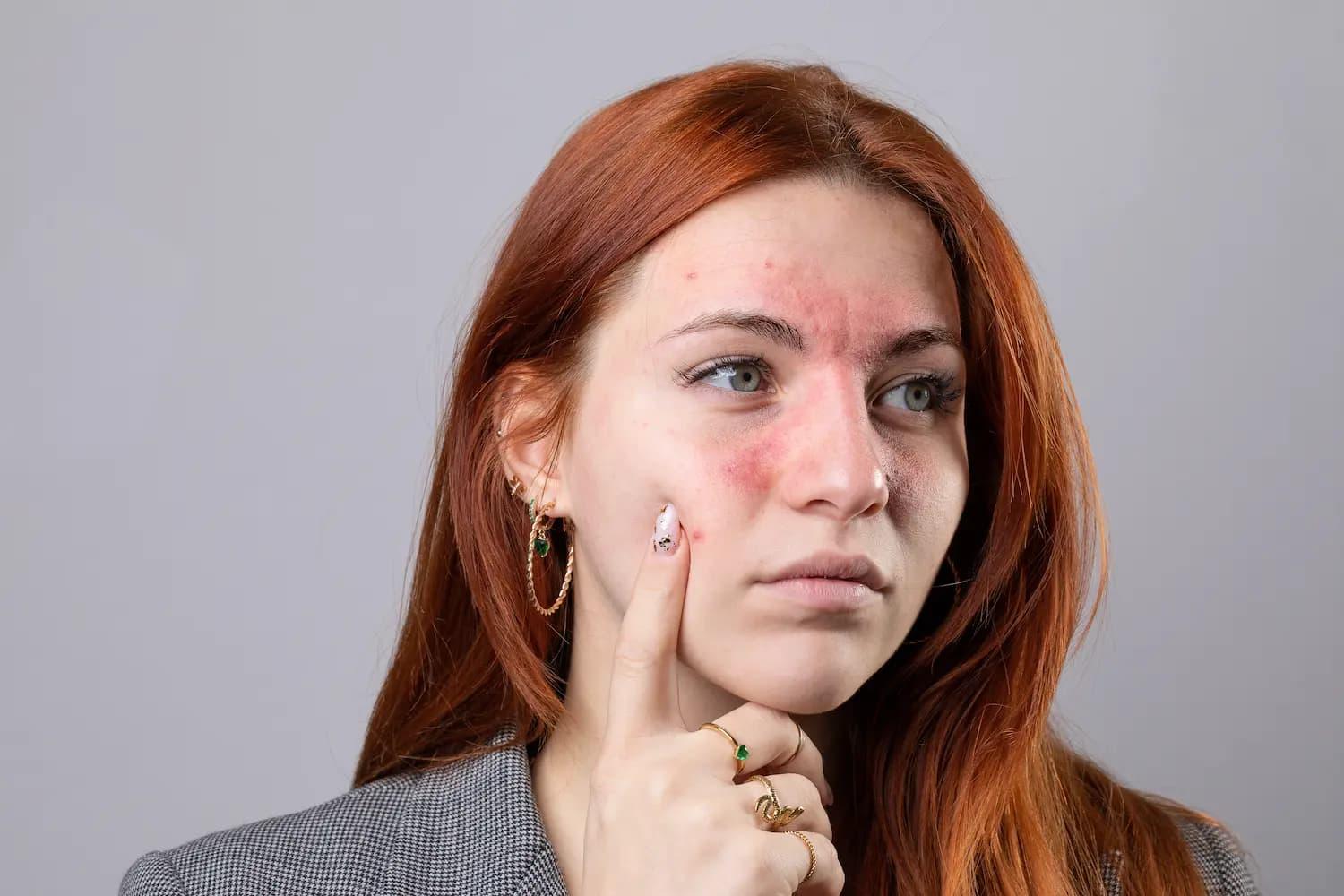 Exame para lúpus: tudo o que você precisa saber sobre a doença