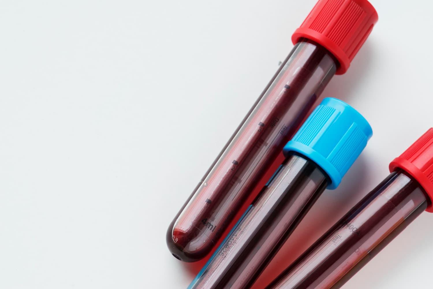 Jejum para exames de sangue: como funciona e no que influencia | Diagnósticos do Brasil: Referência em Apoio Laboratorial