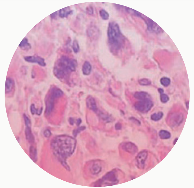 BIÓPSIA DE MEDULA ÓSSEA BIÓPSIA DE MEDULA ÓSSEA